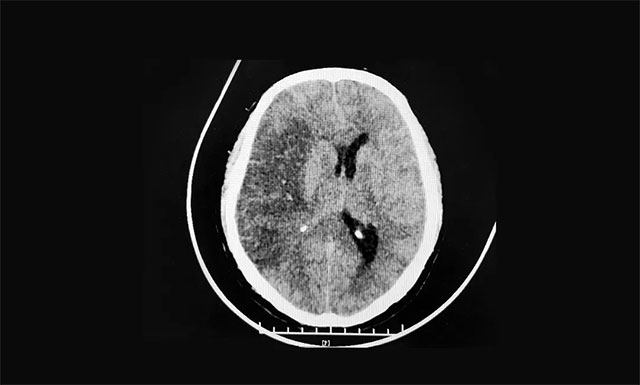 ����e��Ѫ���X����