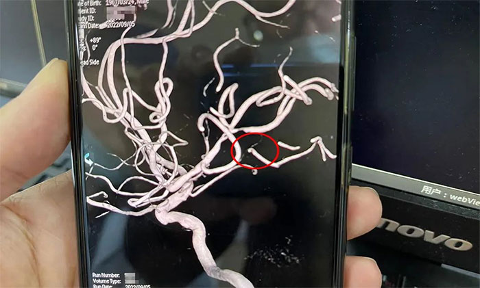 Ѫ�ܴ���g(sh��)��ͨ�X��Ѫ �X���������Ÿ��x�t(y��)Ժ